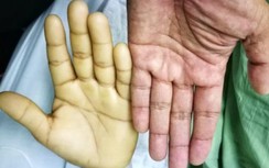 9 dấu hiệu chứng tỏ bạn đã bị ung thư đại trực tràng mà vẫn không hề hay biết