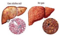 Cả triệu người mắc ung thư gan, gan nhiễm mỡ mà không biết những "thần dược" này
