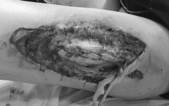 Từ vụ nữ CĐV bị trúng pháo sáng: Chuyên gia y tế cảnh báo tác hại cực kỳ nguy hiểm