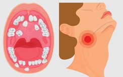 Có những dấu hiệu này, khám ngay ung thư miệng kẻo "hối không kịp"