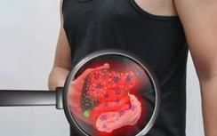 Nếu có 4 thói quen này, sớm muộn bạn sẽ bị gan nhiễm mỡ