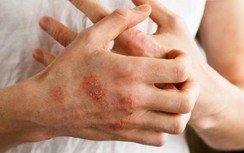 4 thay đổi ở tay chân chứng tỏ lượng đường huyết trong máu tăng đột ngột