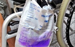 Hội chứng nước tiểu màu tím hiếm gặp khiến nhiều người sợ hãi