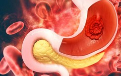 Trắc nghiệm: Những món nên và không nên ăn đối với người mắc ung thư dạ dày?