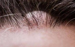 Trên đầu xuất hiện mụn bọc mụn mủ có thể là dấu hiệu của 4 bệnh này