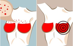 Có 6 dấu hiệu này ở ngực, nguy cơ bạn mắc các bệnh nguy hiểm rất cao