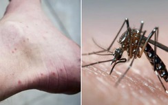 Ghi nhận trường hợp đầu tiên sốt xuất huyết có thể lây qua đường tình dục