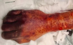 Chỉ vì bị chó cưng liếm, người đàn ông tử vong vì nhiễm trùng