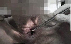 Kinh hãi 30 con giòi làm tổ lúc nhúc trong khí quản cụ ông ở Quảng Ninh