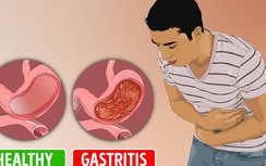12 triệu chứng bạn đã mắc bệnh viêm dạ dày mà không hay biết