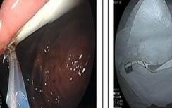 Vừa đánh răng vừa cười, cô gái nuốt trọn chiếc bàn chải vào dạ dày
