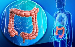 Nhiều người Việt vô tình rước ung thư đại tràng vì không biết những điều này