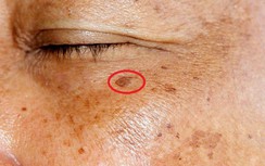 Nếu thấy 3 dấu hiệu này trên mặt, có thể gan bạn đang bị xơ cứng