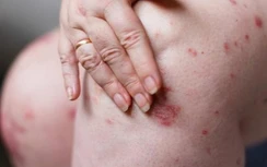 Người phụ nữ đột nhiên xuất hiện những chấm đỏ, được chẩn đoán mắc ung thư gan