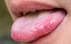 Vết loét ở lưỡi không lành, người đàn ông sốc khi biết tin ung thư