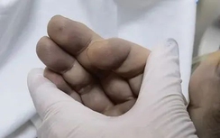 Người đàn ông có màu da bất thường do hay ăn món này trong tủ lạnh