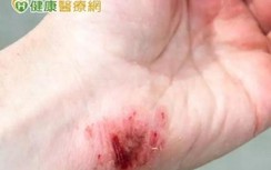 Người đàn ông suýt tử vong khi làm cá, đừng chủ quan với vết thương này