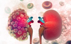 Người đàn ông không phù nhưng suy thận: Bác sĩ nhắc chớ đụng 3 món