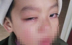 Tin mới vụ cô giáo bị tố lấy thước kẻ đánh vào mắt học sinh