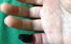 Dùng thuốc chữa mụn cóc tại nhà, bé gái 6 tuổi bị hoại tử ngón tay