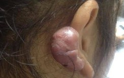 Lãnh cả búi sẹo lồi vì xỏ khuyên vành tai