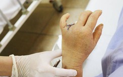 Cụt 2 đốt ngón tay vì để mắc nhẫn vào đinh ốc ở cửa xe ô tô