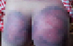 Xử phạt người cha đánh bé gái 8 tuổi bầm tím người chỉ vì học kém hơn anh