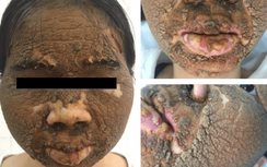 Kinh hãi da mặt sần như vỏ cây vì bôi kem làm trắng