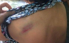 Quảng Ninh: Nghi vấn cháu ngoại đánh bà gãy 5 xương sườn