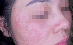 Chữa nám da mặt, cẩn trọng “tiền mất, tật mang”