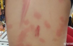 Tiền Giang: Một học sinh lớp 8 nghi bị cô ruột bạo hành