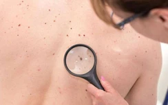 Đừng chủ quan với nốt ruồi lạ trên cơ thể