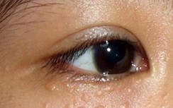 Mụn thịt quanh mắt điều trị như thế nào cho hiệu quả?