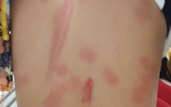 Khởi tố người cô bạo hành cháu ruột gây thương tích 13%