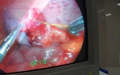 Nguy hại khó lường do thói quen "ngậm tăm" của hàng triệu người Việt