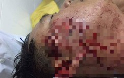 Vì sao đại úy công an Sóc Trăng bị thanh niên đập ly bia vào mặt?