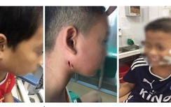 Tất cả thông tin cần biết về bệnh "ăn thịt người" - Whitmore nguy hiểm