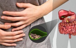 Xơ gan vì sỏi mật, bệnh nhân không ngờ thói quen này là thủ phạm gây bệnh