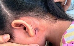 Thêm một bệnh nhi 5 tuổi mắc bệnh Whitmore