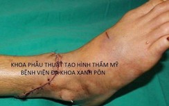 Kỳ diệu nối thành công bàn chân đứt lìa cho người đàn ông ở Quảng Ninh