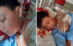 Xác minh nghi vấn bé trai bị cha ruột tạt nước sôi gây bỏng nặng