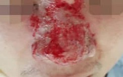 Tiêm filler nâng mũi, nam thanh niên 27 tuổi có nguy cơ mù lòa