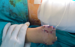 Người đàn ông 44 tuổi nát mặt và cánh tay vì "nghịch dại" pháo tự chế