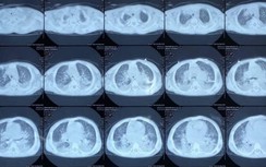 Hải Dương: 1 bệnh nhân người Trung Quốc nghi bị nhiễm virus Corona