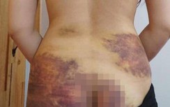 Vụ chồng bạo hành vợ ở Tây Ninh: Xem xét khởi tố hình sự