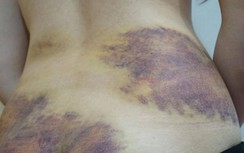 Vụ vợ nghi bị chồng bạo hành ở Tây Ninh: Chưa đủ cơ sở xử lý hình sự