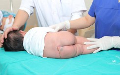 Cắt "đuôi" thành công cho trẻ nhỏ 5 tháng tuổi