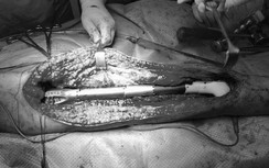 Cô gái trẻ ung thư xương được đi lại bình thường trên đôi chân kim loại