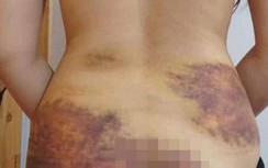 Cô gái 27 tuổi bị chồng bạo hành, ép quan hệ ở Tây Ninh có thương tật 4%