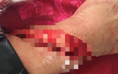 Người phụ nữ bị chồng "hờ" dùng dao chém vào đầu, tay gây thương tích
